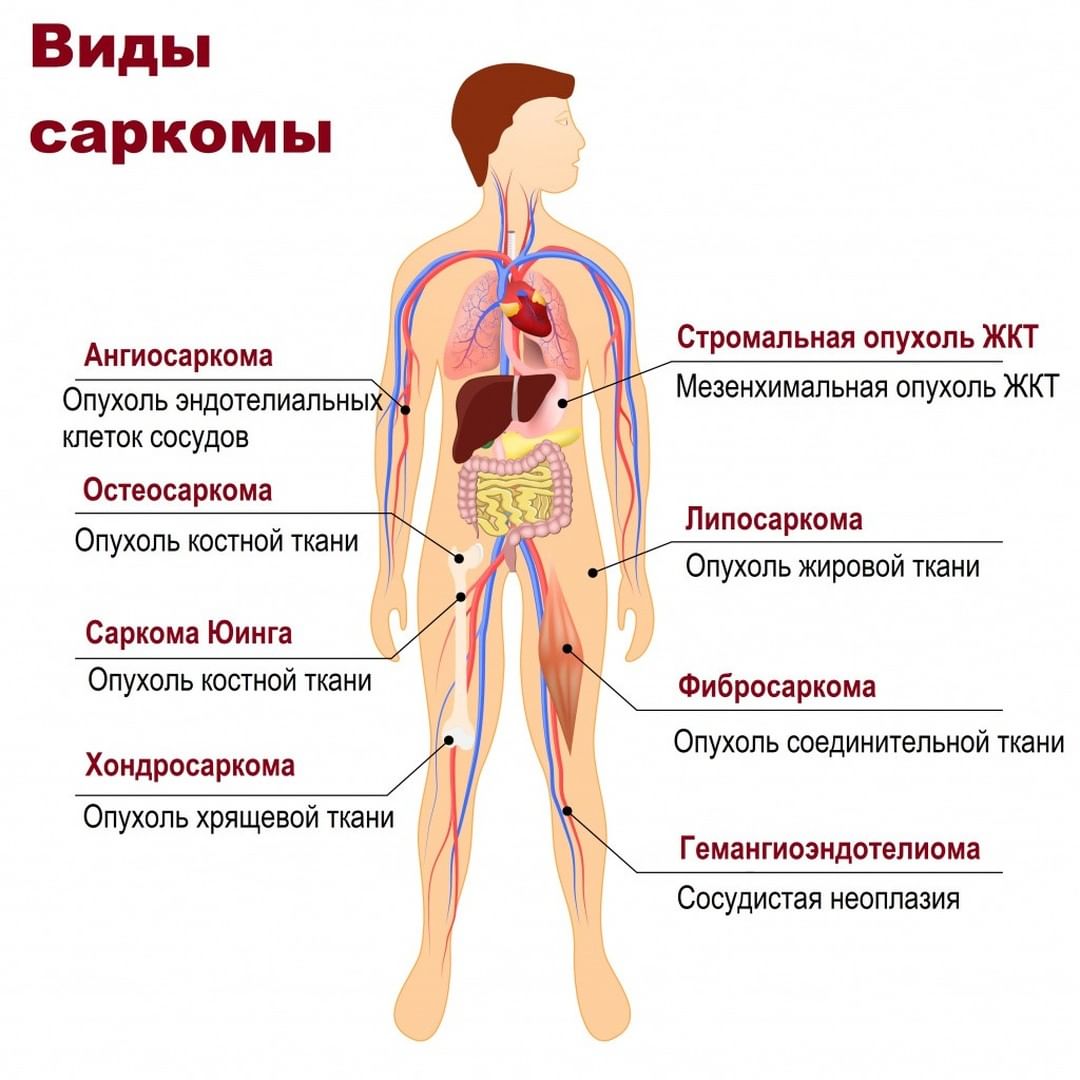 Особенности сарком. Саркома Капоши патогенез. Саркома Капоши классификация. Опухоли соединительнотканного происхождения. Капоши саркома химиотерапия.